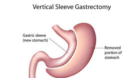 CPT code for Gastrectomy - simplify medical coding