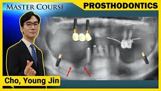 [Master Course Season2 -PROSTHODONTICS] Implant - Assisted RPD