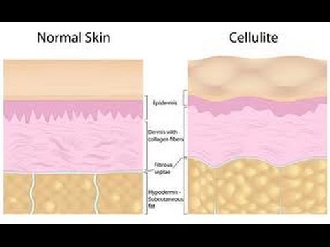 how cellulite forms and how to derail it from forming youtube why does cellulite form