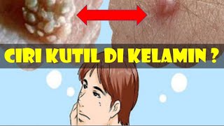 Ciri Ciri Gejala Kutil Kelamin | Penyebab Kutil Kelamin & Obat Kutil Kelamin