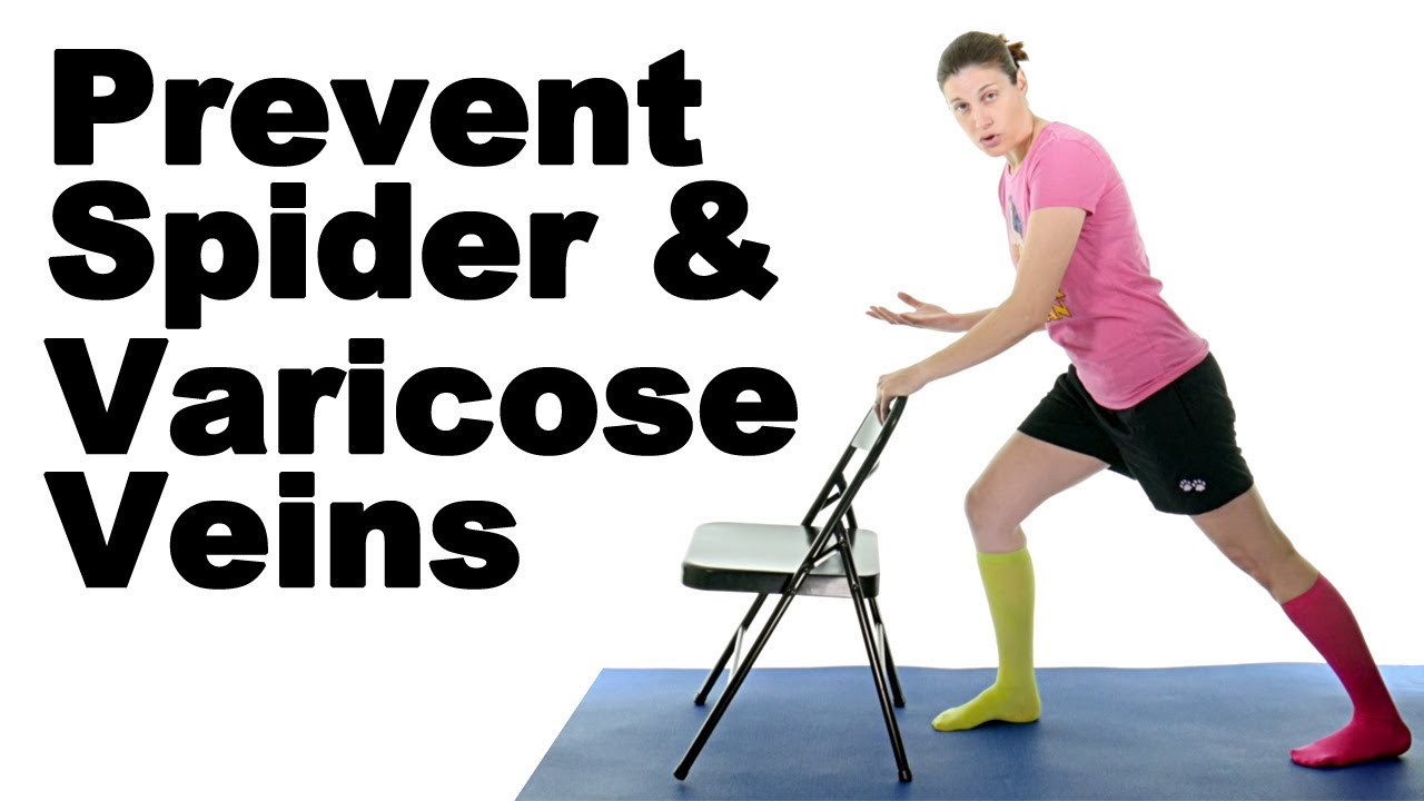 can varicose veins disappear with exercise)