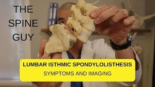 Lumbar Isthmic Spondylolisthesis  Part 1   Imaging and Symptoms
