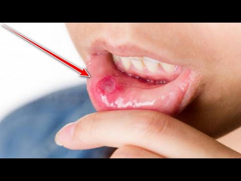 Συχνές άφθες στο στόμα: Πότε δείχνουν σοβαρό πρόβλημα υγείας