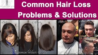 Different Types of Women Hair Loss Solutions & Where to get them
