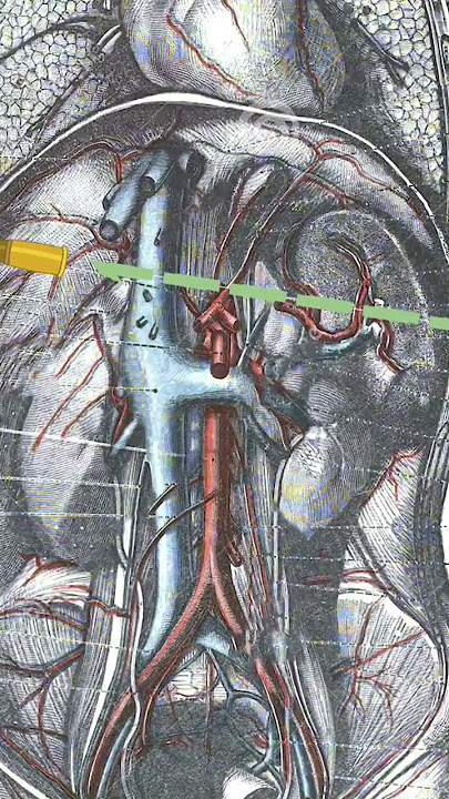 The most famous injury in all of trauma surgery!!