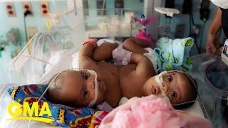 Conjoined twin sisters successfully separated in historic surgery at Texas hospital