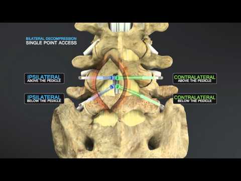 Education video on LumbarEducation video on LumbarStenosisEducation video on LumbarEducation video o. 