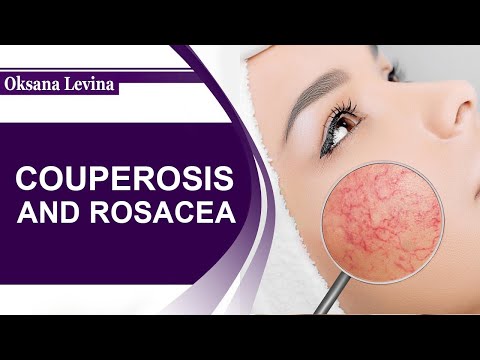 Video: Kan Du Gjøre Ansikts Peeling For Rosacea?