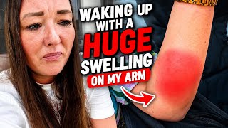 Waking up with a HUGE SWELLING on my Arm!