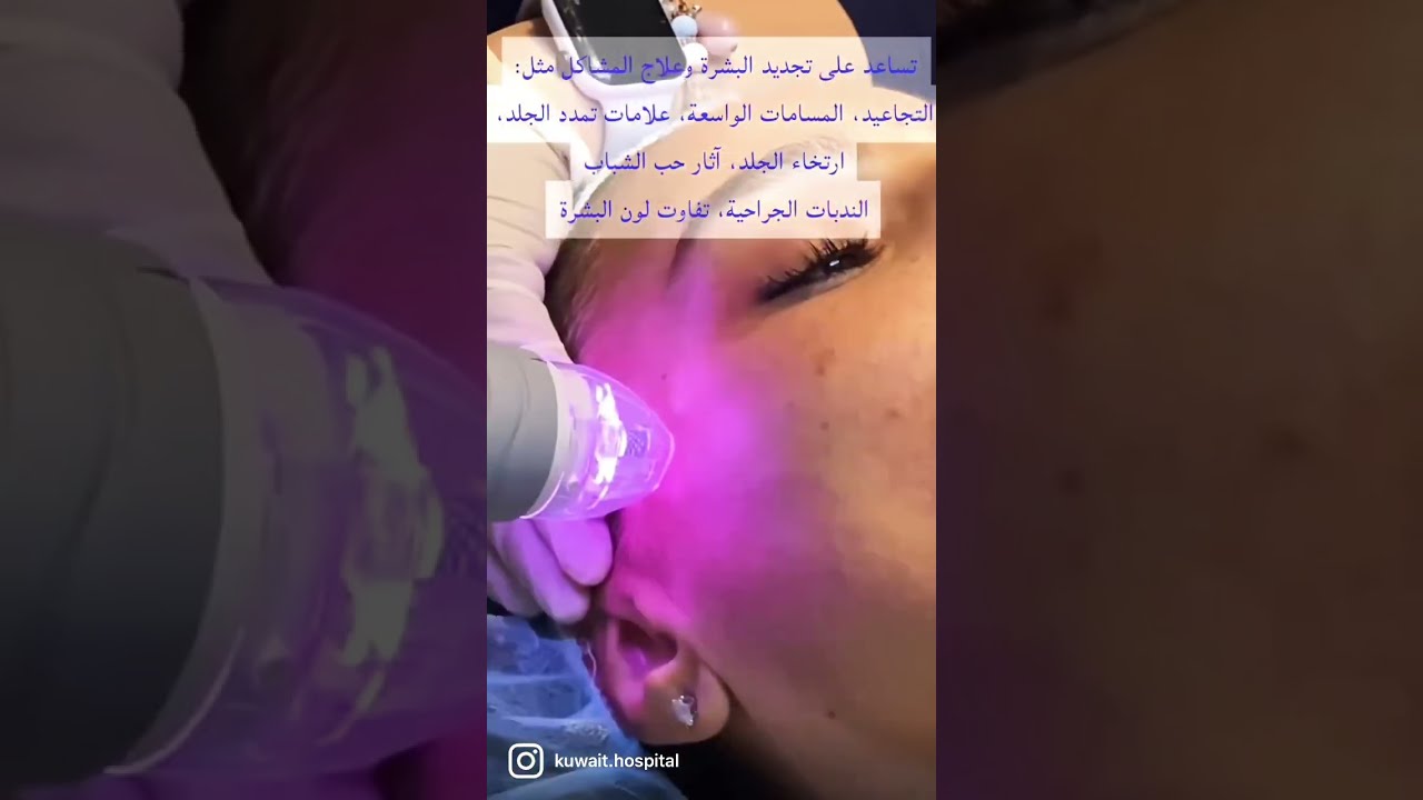 ‎جددي شباب بشرتك الآن مع تقنية فيفاشي الحديثة