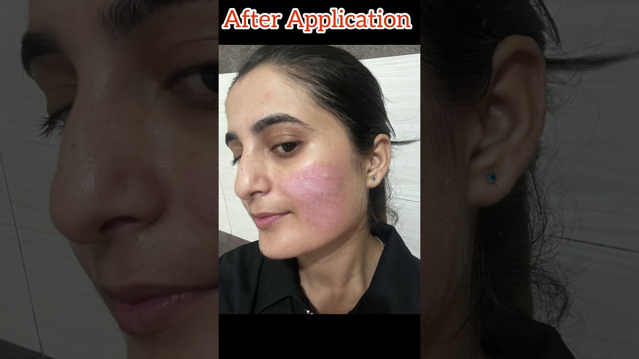 25%TCA Chemical Peel At Home 