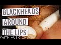 Deep Blackheads Around The Lips with Gebhard (Re-upload with music only)