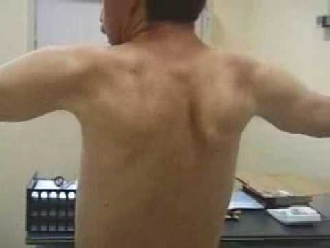 nooit variabel schuif Scapula alata - YouTube