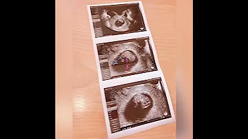 ダウン症 妊娠発覚 エコー動画 