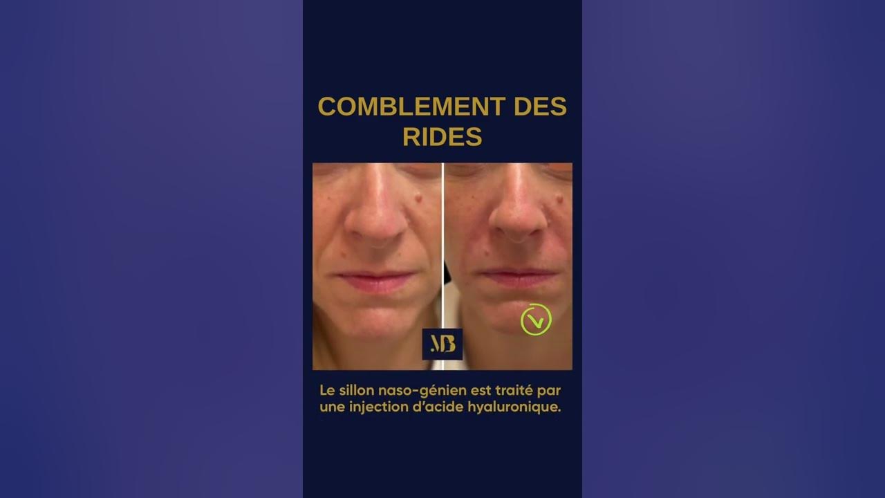 Comblement des rides du visage - sillon naso-génien par médecine ...