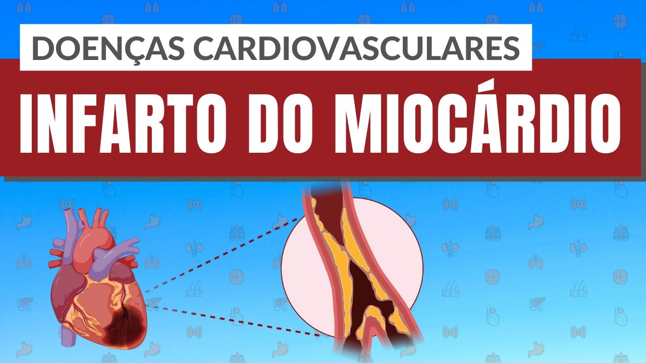 o que é infarto agudo do miocardio sinais e sintomas