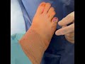 “Most Satisfying Fifth Toe Correction You’ll See Today 👀”