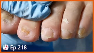 Ep.218 - 5 fungus toenail on 1 foot
