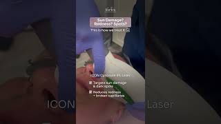 ICON Cynosure IPL Laser for Sun damage,  Redness,  and Spots.