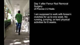 Femur Rod Removal - Day 1 (Precice 2.2 Nails and Syndesmotic Screws)