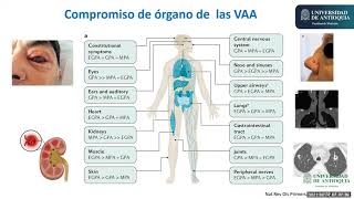 Guía para el Tratamientos de la Vasculitis asociada a ANCA  Dr. Andrés Ramírez