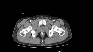 CASE 993 CT ABDOMEN FOCAL HEMATOMA
