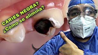 ¿CARIES PROFUNDA?  RESINA DENTAL, INCRUSTACION ESTÉTICA Y CORONA DE PORCELANA #1 (odontología)