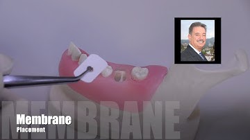 Membrane Placement over Extraction Sockets - Surgical Esthetics
