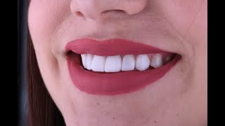 CEREC Same Day Veneers
