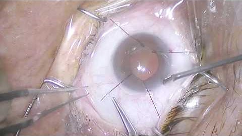 Iris Hooks- Cataract 1