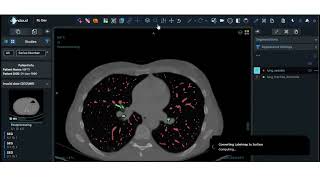 DCMCloud helps you visualize lung vessels with clarity.