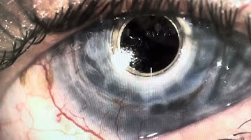 K-Pro Artificial Cornea