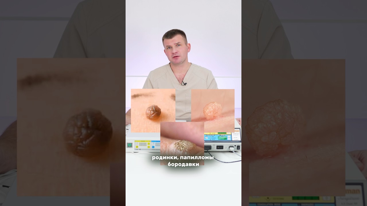 Папилломы, бородавки, родинки: как УДАЛИТЬ без шрамов и рубцов?