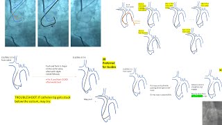 Left EBU/CLS guides manipulations, radial and femoral  Ikari L  Key tips in left coronary engagement