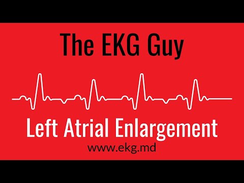 Left Atrial Enlargement EKG l The EKG Guy - www.ekg.md