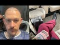 My hair transplant journey chapter i