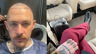 My hair transplant journey chapter I