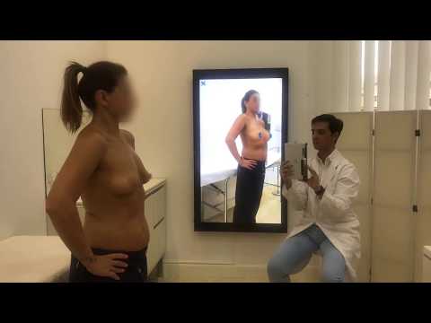 Simulación 4D de aumento de pecho antes de operarse