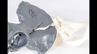 3D printing for orthopedic surgery