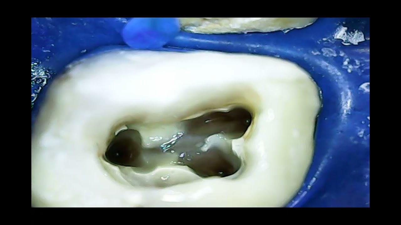 اعادة معالجة لبية مع الدكتور مالك الاشقر