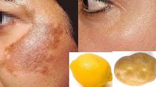 How To Use Potato To Treat Skin Pigmentation, Dark Spots, Acne Scars Easily At Home/Home Remedies.