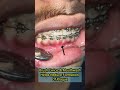 Gum recession youtubeshorts ytshorts dentaltips