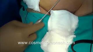 Penis Enlargement India Small Penis Fat Graft injection Delhi..