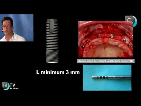 Vidéo: Implants - Vue Alternative