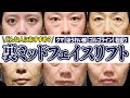 【目の下のたるみ】どんな人におすすめ!?裏ハムラ+ミッドフェイスリフトを解説