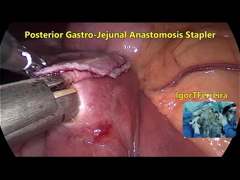 Bariatric Surgery - Gastric ByPass - July 2016 - Laparoscopic + GoPro FullHD