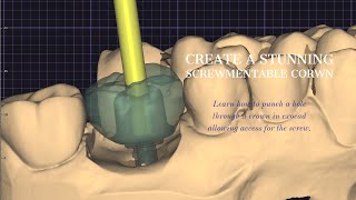 Ultimate Tutorial: Screw Retained Implant Crown in Exocad - Step by Step Guide