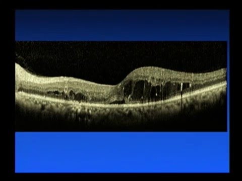 Video: Diabetisch Macula-oedeem: Symptomen, Behandeling En Meer