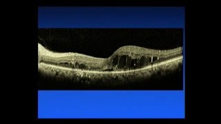 Diabetic Macular Edema - Saving Sight 2014