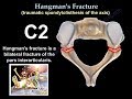 Hangman's Fracture, C2 Fracture - Everything You Need To Know - Dr. Nabil Ebraheim
